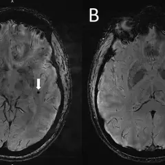 Rezonans magnetyczny głowy pokazuje zmiany, które mogą pomóc w diagnostyce chorób psychicznych, np. małe ogniska krwotoczne.