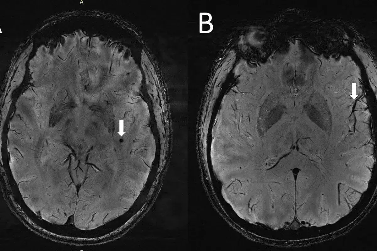 Rezonans magnetyczny głowy a choroby psychiczne - co pokazuje